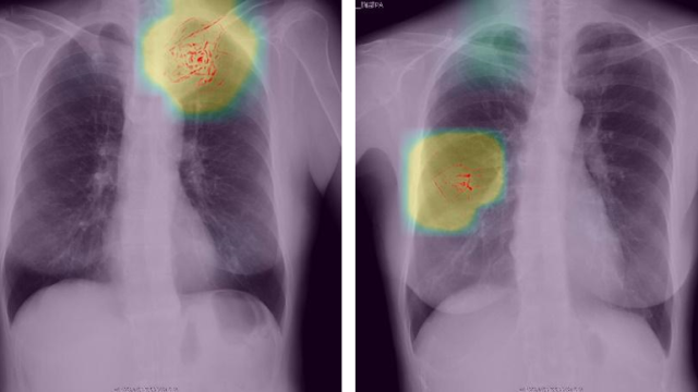 Preferred Networks Uses Deep Learning to Help Kyoto Physicians Diagnose Lung Cancer from Chest X-Ray Images